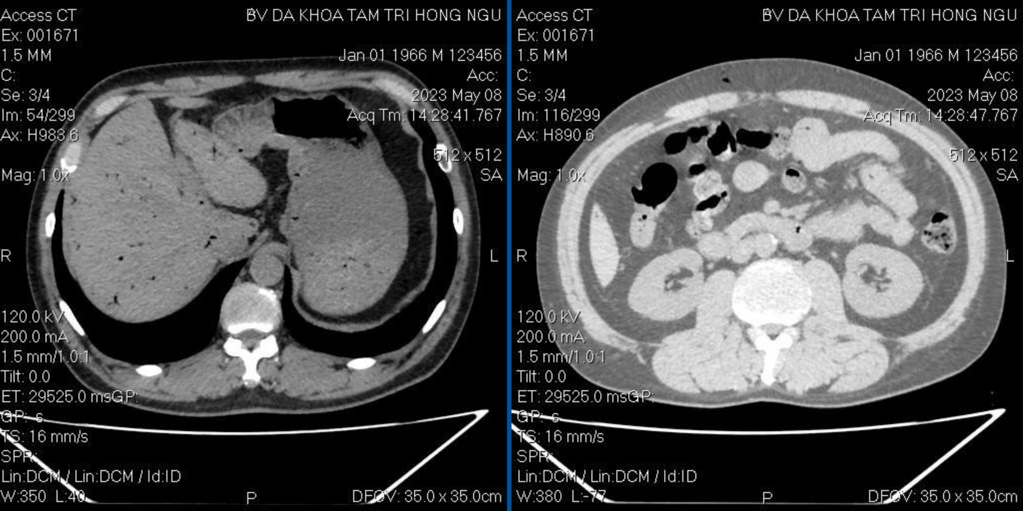 ct_scan